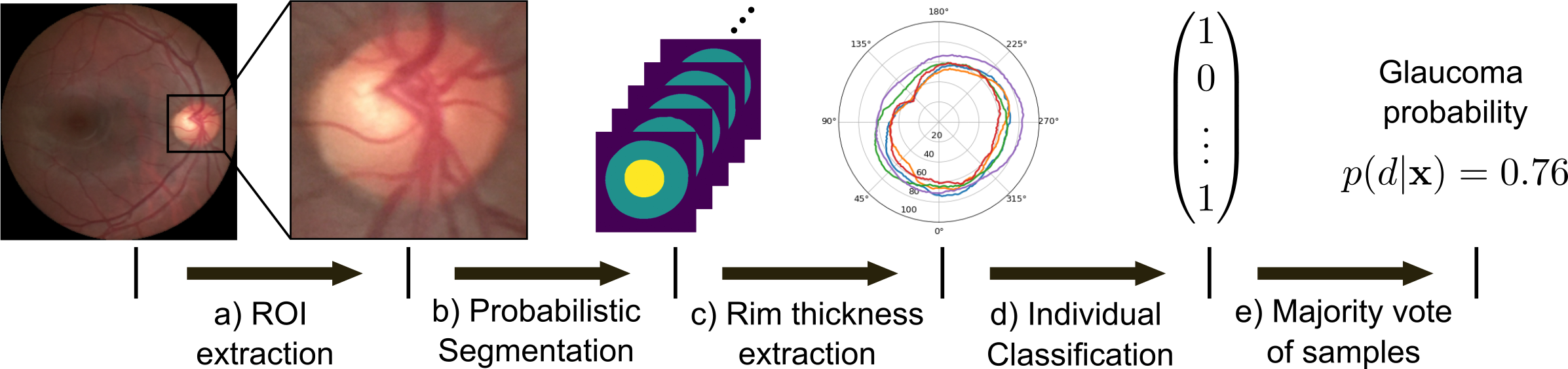 Figure for Leveraging Probabilistic Segmentation Models for Improved Glaucoma Diagnosis: A Clinical Pipeline Approach